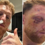 Ben Stokes face surgery