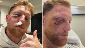 Ben Stokes face surgery