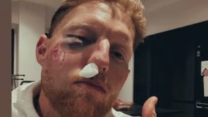 Ben Stokes facial injury